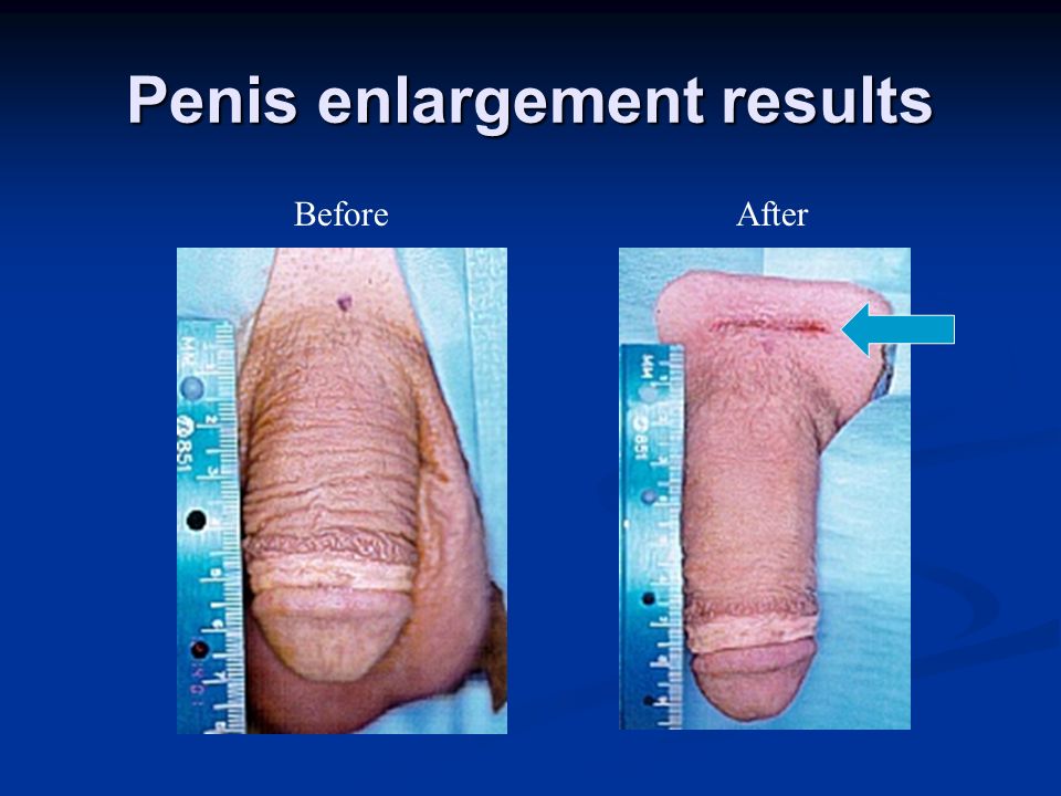 Penis Enlargement Results 59