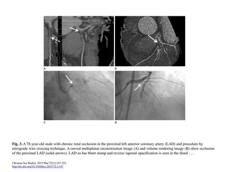 Fig. 3. A 78-year-old male with chronic total occlusion in the proximal left anterior coronary artery (LAD) and procedure by retrograde wire crossing technique.