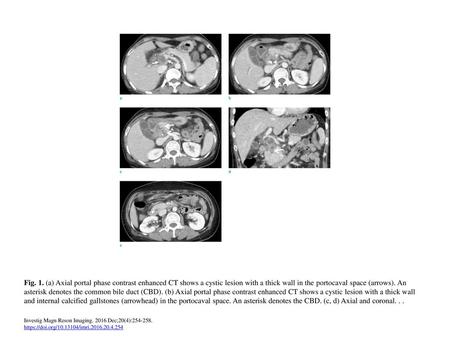 Fig. 1. (a) Axial portal phase contrast enhanced CT shows a cystic lesion with a thick wall in the portocaval space (arrows). An asterisk denotes the common.