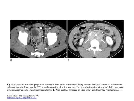 Fig. 5. 28-year-old man with lymph-node metastasis from pelvic extraskeletal Ewing sarcoma family of tumors. A. Axial contrast-enhanced computed tomography.