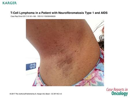 T-Cell Lymphoma in a Patient with Neurofibromatosis Type 1 and AIDS