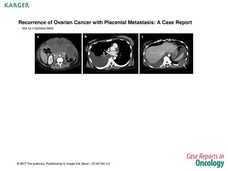 Recurrence of Ovarian Cancer with Placental Metastasis: A Case Report