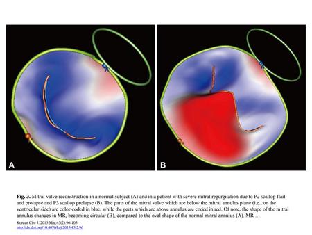 Fig. 3. Mitral valve reconstruction in a normal subject (A) and in a patient with severe mitral regurgitation due to P2 scallop flail and prolapse and.