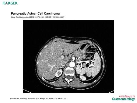 Pancreatic Acinar Cell Carcinoma