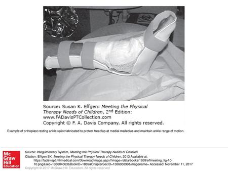 Example of orthoplast resting ankle splint fabricated to protect free flap at medial malleolus and maintain ankle range of motion. Source: Integumentary.
