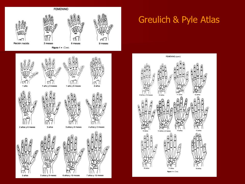 Greulich And Pyle Bone Age Atlas
