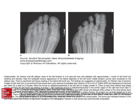 Osteomyelitis. (A) Anterior and (B) oblique views of the left forefoot of a 61-year-old man with diabetes with approximately 1 month of left fourth toe.