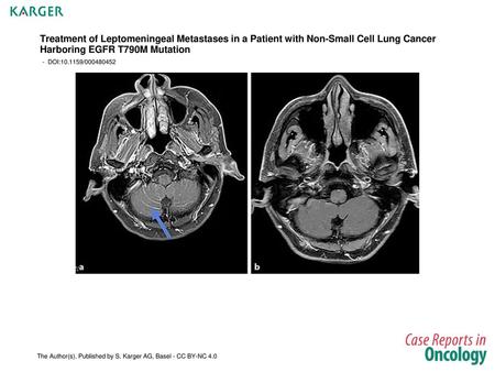 Treatment of Leptomeningeal Metastases in a Patient with Non-Small Cell Lung Cancer Harboring EGFR T790M Mutation - DOI:10.1159/000480452 Fig. 1. a Brain.