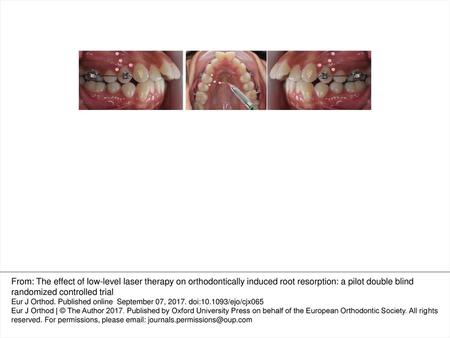 Figure 1. Orthodontic set-up and location of LLLT or placebo-laser