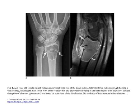 Fig. 1. A 35-year-old female patient with an aneurysmal bone cyst of the distal radius. Anteroposterior radiograph (A) showing a well-defined, radiolucent.