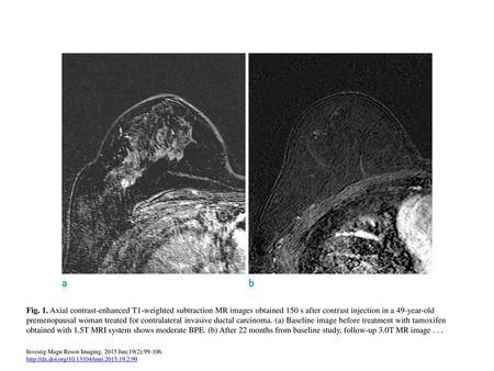 Fig. 1. Axial contrast-enhanced T1-weighted subtraction MR images obtained 150 s after contrast injection in a 49-year-old premenopausal woman treated.