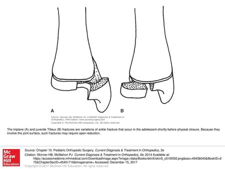 The triplane (A) and juvenile Tillaux (B) fractures are variations of ankle fracture that occur in the adolescent shortly before physeal closure. Because.