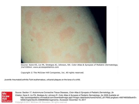 Juvenile rheumatoid arthritis Faint erythematous, urticarial plaques on the torso of a child. Source: Section 17. Autoimmune Connective Tissue Diseases,