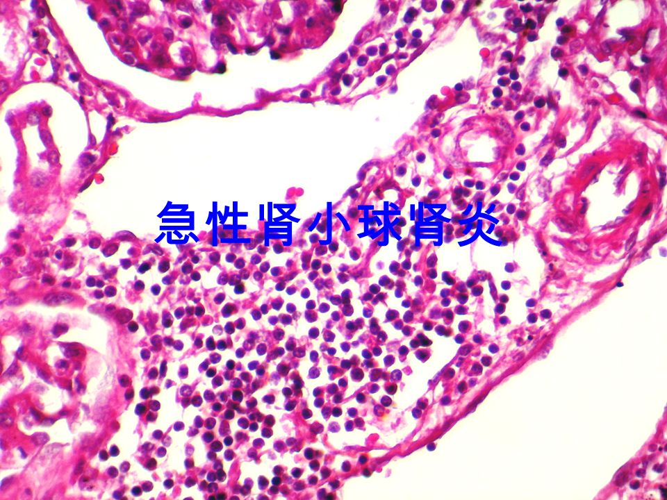 57                 新月体性肾小球