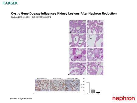 Cystic Gene Dosage Influences Kidney Lesions After Nephron Reduction