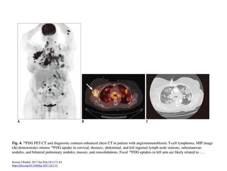 Fig. 4. 18FDG PET-CT and diagnostic contrast-enhanced chest CT in patient with angioimmunoblastic T-cell lymphoma. MIP image (A) demonstrates intense 18FDG.