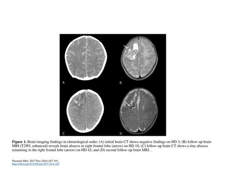 Figure 1. Brain imaging findings in chronological order: (A) initial brain CT shows negative findings on HD 3; (B) follow-up brain MRI (T2WI, enhanced)