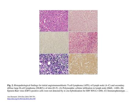 Fig. 2. Histopathological findings for initial angioimmunoblastic T-cell lymphoma (AITL) of lymph node (A~C) and secondary diffuse large B-cell lymphoma.