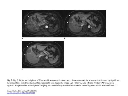 Fig. 3. Fig. 3. Triple arterial phase of 70-year-old woman with colon cancer liver metastasis.1st scan was deteriorated by significant motion artifacts.