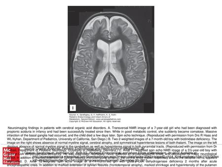 Neuroimaging findings in patients with cerebral organic acid disorders