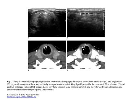 Fig. 2. Fatty tissue mimicking thyroid pyramidal lobe on ultrasonography in 49-year-old woman. Transverse (A) and longitudinal (B) gray-scale sonograms.