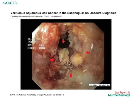 Verrucous Squamous Cell Cancer in the Esophagus: An Obscure Diagnosis