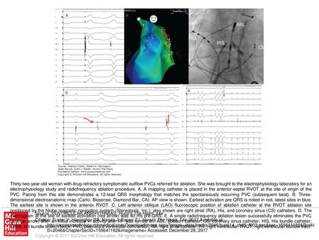 Thirty-two-year-old woman with drug-refractory symptomatic outflow PVCs referred for ablation. She was brought to the electrophysiology laboratory for.