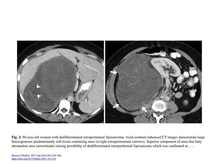 Fig year-old woman with dedifferentiated retroperitoneal liposarcoma