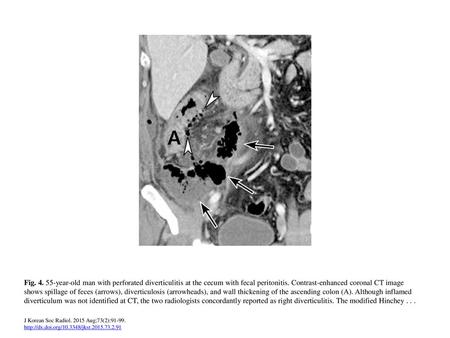 Fig. 4. 55-year-old man with perforated diverticulitis at the cecum with fecal peritonitis. Contrast-enhanced coronal CT image shows spillage of feces.