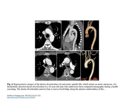 Fig. 4. Representative images of the ductus diverticulum (A) and aortic spindle (B), which mimic an aortic aneurysm. (A) Incidentally detected ductus diverticulum.
