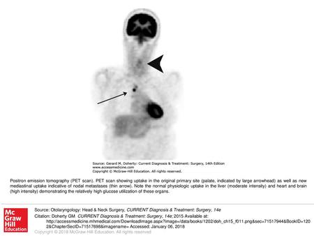 Positron emission tomography (PET scan)