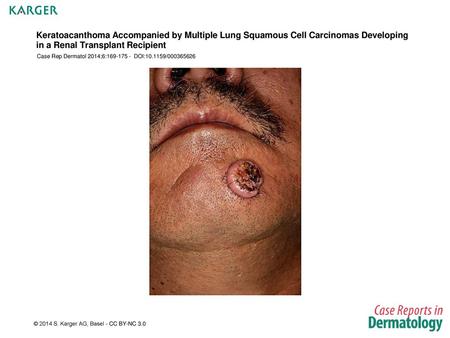 Keratoacanthoma Accompanied by Multiple Lung Squamous Cell Carcinomas Developing in a Renal Transplant Recipient Case Rep Dermatol 2014;6:169-175 - DOI:10.1159/000365626.