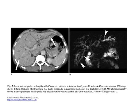 Fig. 7. Recurrent pyogenic cholangitis with Clonorchis sinensis infestation in 62-year-old male. A. Contrast-enhanced CT image shows diffuse dilatation.