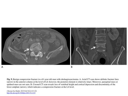 Fig. 9. Benign compression fracture in a 61-year-old man with cholangiocarcinoma. A. Axial CT scan shows definite fracture lines (arrow) in the anterior.