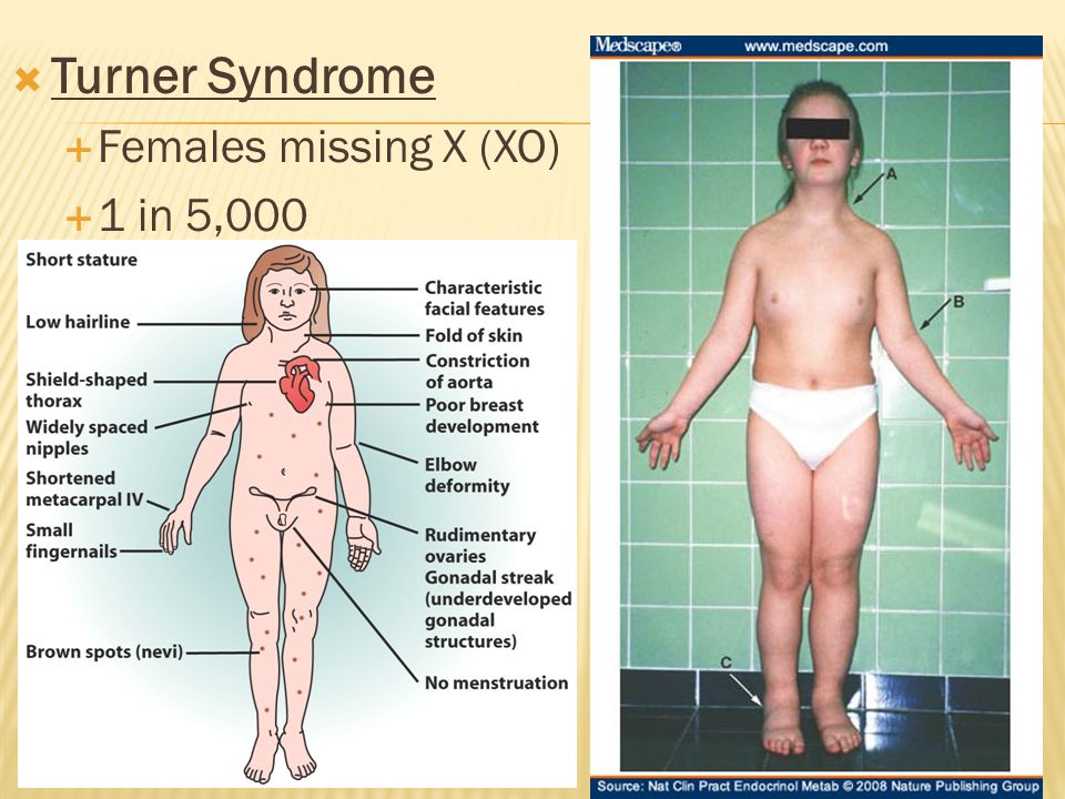 Image result for turner syndrome