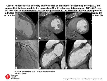 Case of nonobstructive coronary artery disease of left anterior descending artery (LAD) and regional LV dysfunction detected on cardiac CT with subsequent.