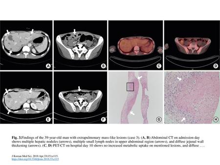 Fig. 3.Findings of the 39-year-old man with extrapulmonary mass-like lesions (case 3). (A, B) Abdominal CT on admission day shows multiple hepatic nodules.