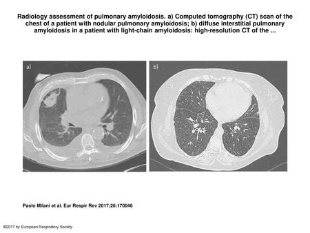 Radiology assessment of pulmonary amyloidosis