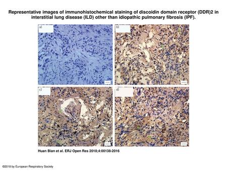 Representative images of immunohistochemical staining of discoidin domain receptor (DDR)2 in interstitial lung disease (ILD) other than idiopathic pulmonary.
