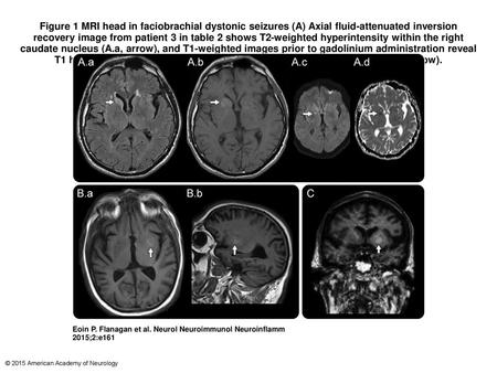 Figure 1 MRI head in faciobrachial dystonic seizures (A) Axial fluid-attenuated inversion recovery image from patient 3 in table 2 shows T2-weighted hyperintensity.