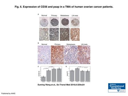 Expression of CD36 and psap in a TMA of human ovarian cancer patients