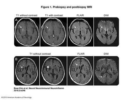 Figure 1. Prebiopsy and postbiopsy MRI