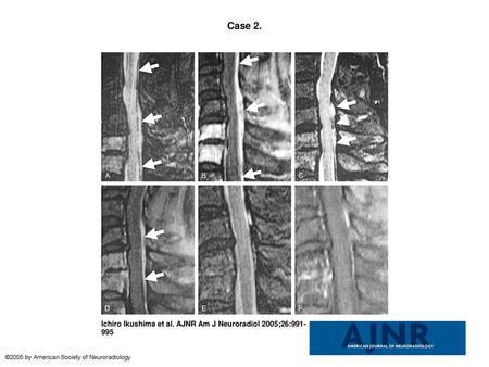 Case 2. Case 2. A 66-year-old man who received epidural anesthesia and underwent MR imaging 2 days (A and B), 2 months (C and D), and 5 months (E and F)