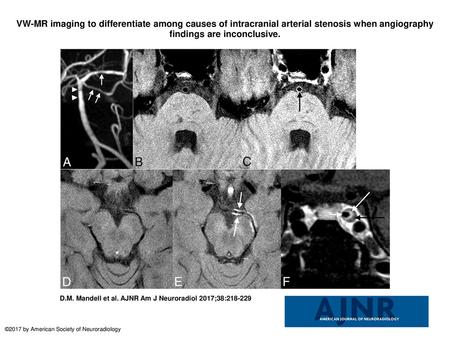 VW-MR imaging to differentiate among causes of intracranial arterial stenosis when angiography findings are inconclusive. VW-MR imaging to differentiate.
