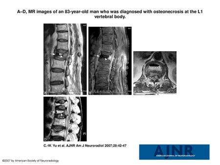 A–D, MR images of an 83-year-old man who was diagnosed with osteonecrosis at the L1 vertebral body. A–D, MR images of an 83-year-old man who was diagnosed.