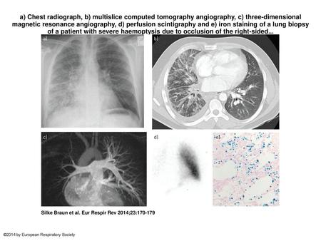 A) Chest radiograph, b) multislice computed tomography angiography, c) three-dimensional magnetic resonance angiography, d) perfusion scintigraphy and.