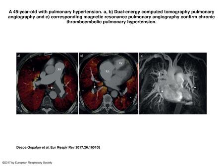 A 45-year-old with pulmonary hypertension