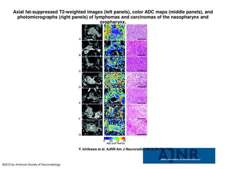 Axial fat-suppressed T2-weighted images (left panels), color ADC maps (middle panels), and photomicrographs (right panels) of lymphomas and carcinomas.