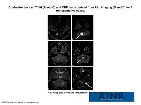 Contrast-enhanced T1WI (A and C) and CBF maps derived from ASL imaging (B and D) for 2 representative cases. Contrast-enhanced T1WI (A and C) and CBF maps.