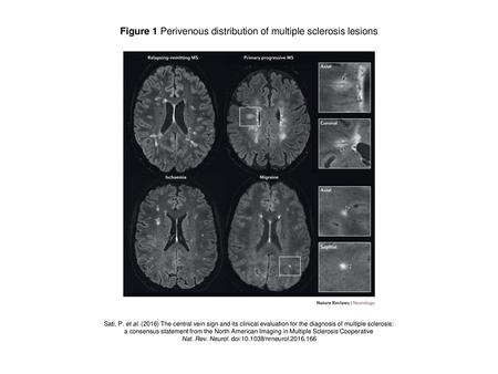 Figure 1 Perivenous distribution of multiple sclerosis lesions